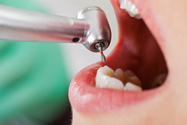 Best Emergency Treatment for Dental Infections or Abscesses in Seymour, TX